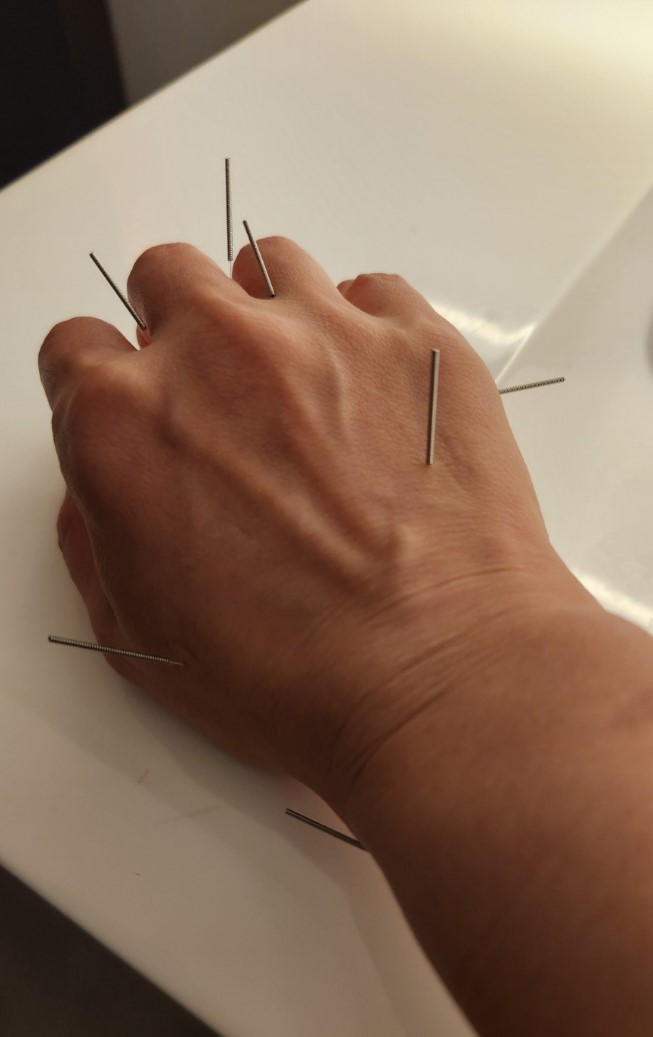 Classic acupuncture treatment